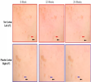 V2G (Ascorbyl Glucoside)